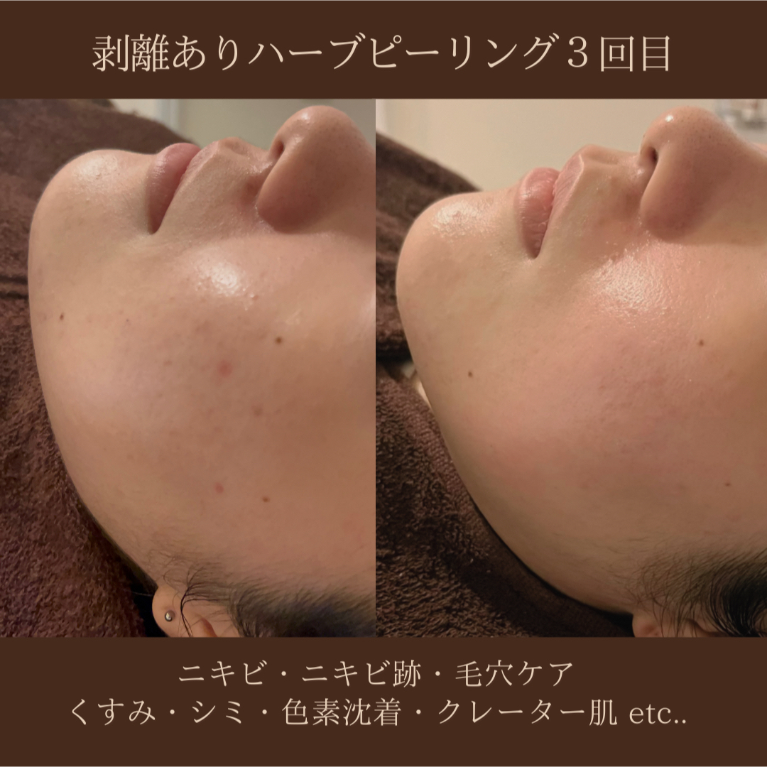 専用ハーブピーリング剥離無し 10回分（11月11日から2月20日の間発送