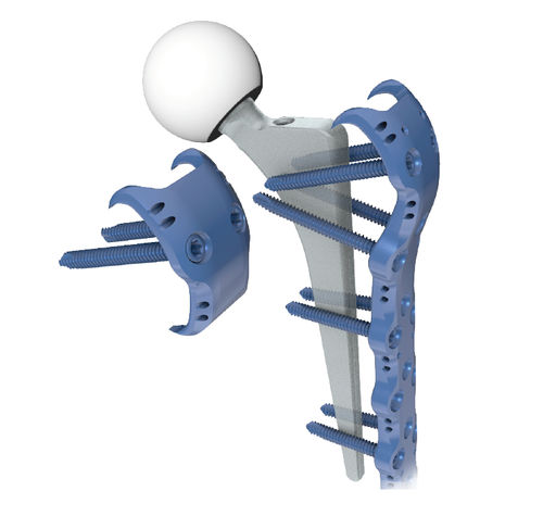 大腿骨人工関節周囲骨折用圧迫プレート - 3.72 series - ChM - 近位部