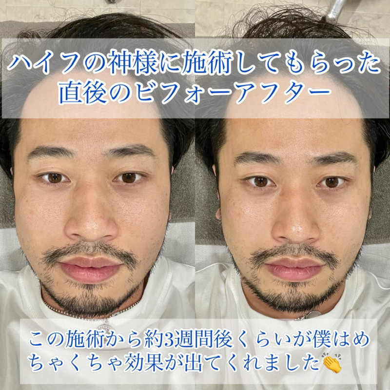 マツコの知らない世界でも紹介】まるでハイフ？全身の造形美を叶える