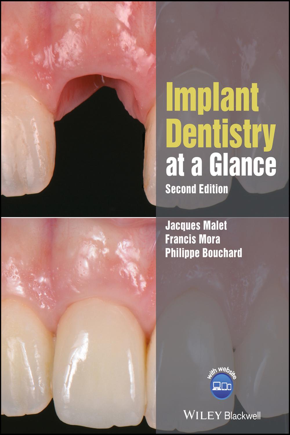 PDF] Implant Dentistry at a Glance by Jacques Malet, 2nd edition
