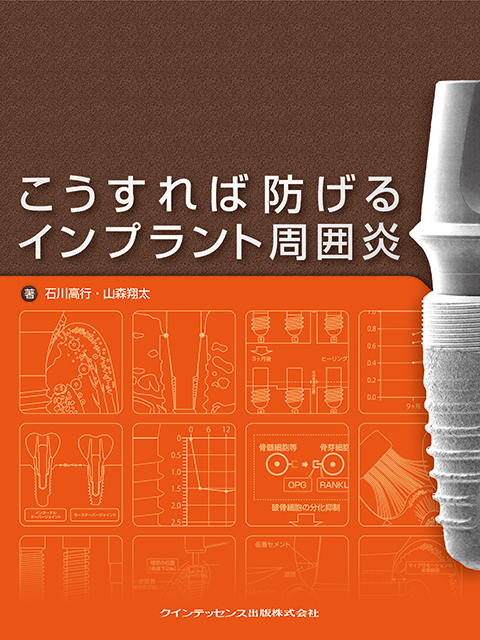 こうすれば防げるインプラント周囲炎 - クインテッセンス出版