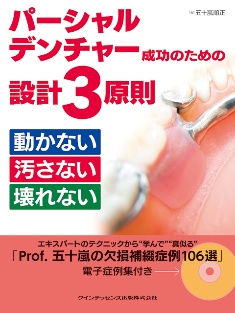 パーシャルデンチャー成功のための設計3原則 動かない 汚さない 壊れ