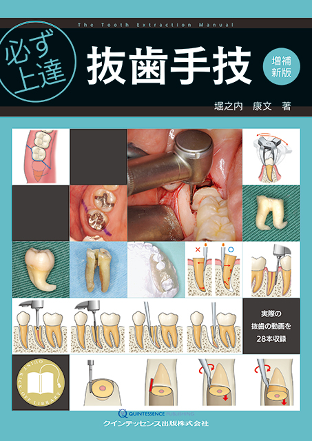 必ず上達 抜歯手技 増補新版 - クインテッセンス出版