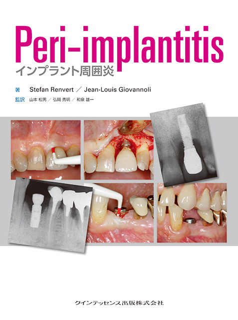 歯周病患者におけるインプラント治療のガイドライン