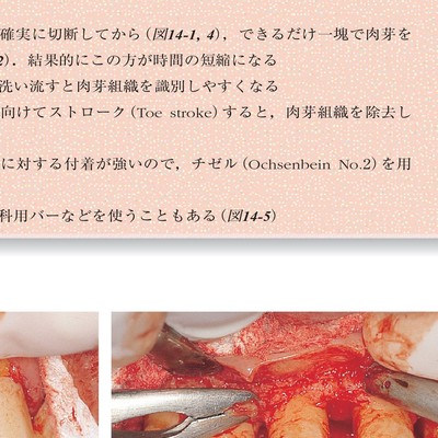 コンセプトを持った予知性の高い歯周外科処置