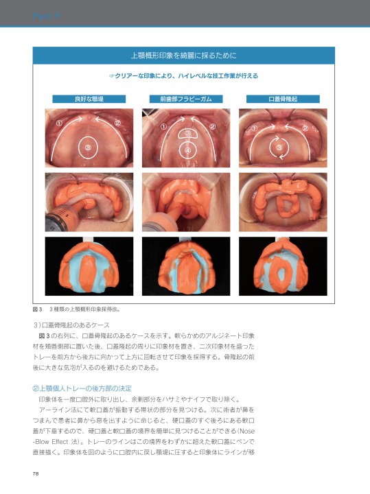 下顎総義歯吸着テクニック ザ・プロフェッショナル