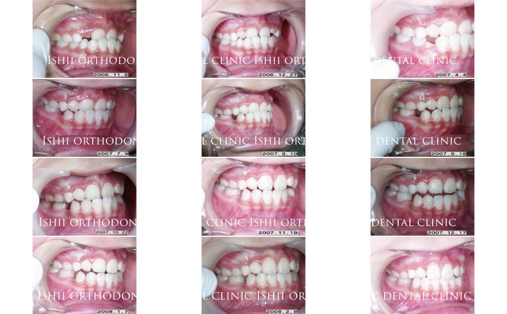 取り外しの床矯正装置で改善できる反対咬合 album 253 | 石井歯科矯正