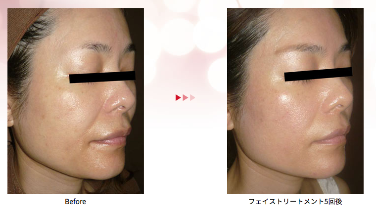 エンダモリフト | イスタナロゼ