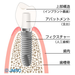 インプラント - 三重県鈴鹿市の歯医者、小児歯科、往診は岩沢歯科(岩澤