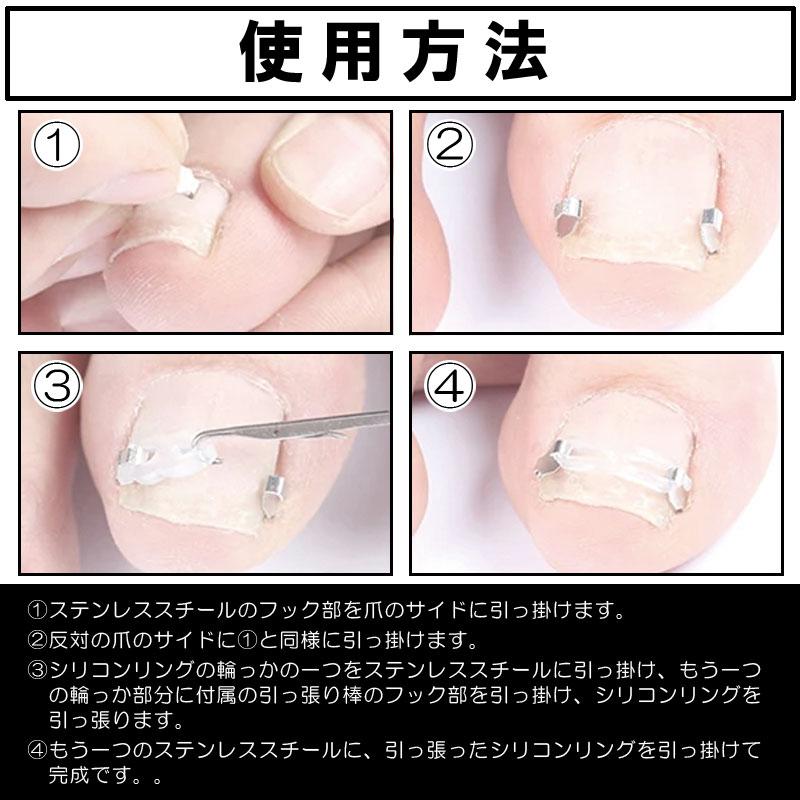 まきづめ 巻き爪 ケア ネイルケア ガード 巻き爪ブロック 巻き爪