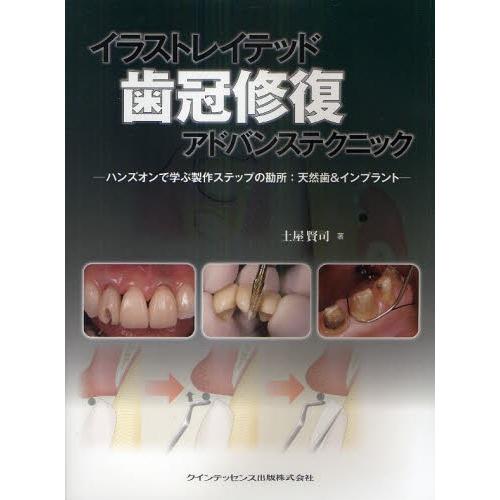 イラストレイテッド歯冠修復アドバンステクニック ハンズオンで学ぶ