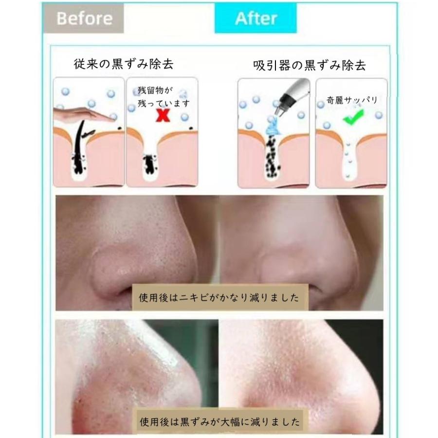 吸引器 ニキビ 毛穴吸引 角質 角栓 ニキビケア 美顔器 5段階吸引力