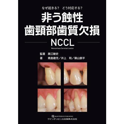 非う蝕性歯頸部歯質欠損 NCCL : 有隣堂ヤフーショッピング店 - 通販