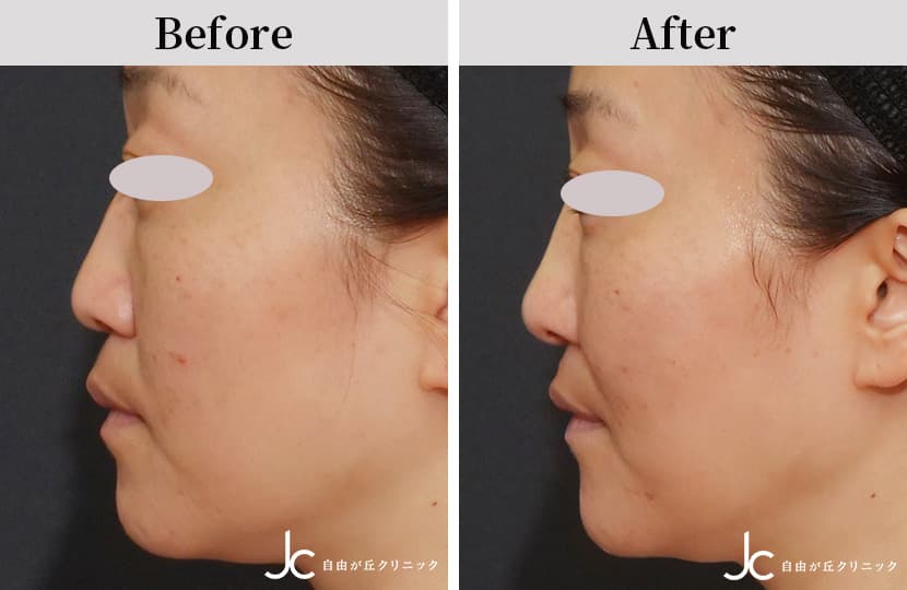 ヒアルロン酸注射なら自由が丘クリニック【注入療法専門サイト】