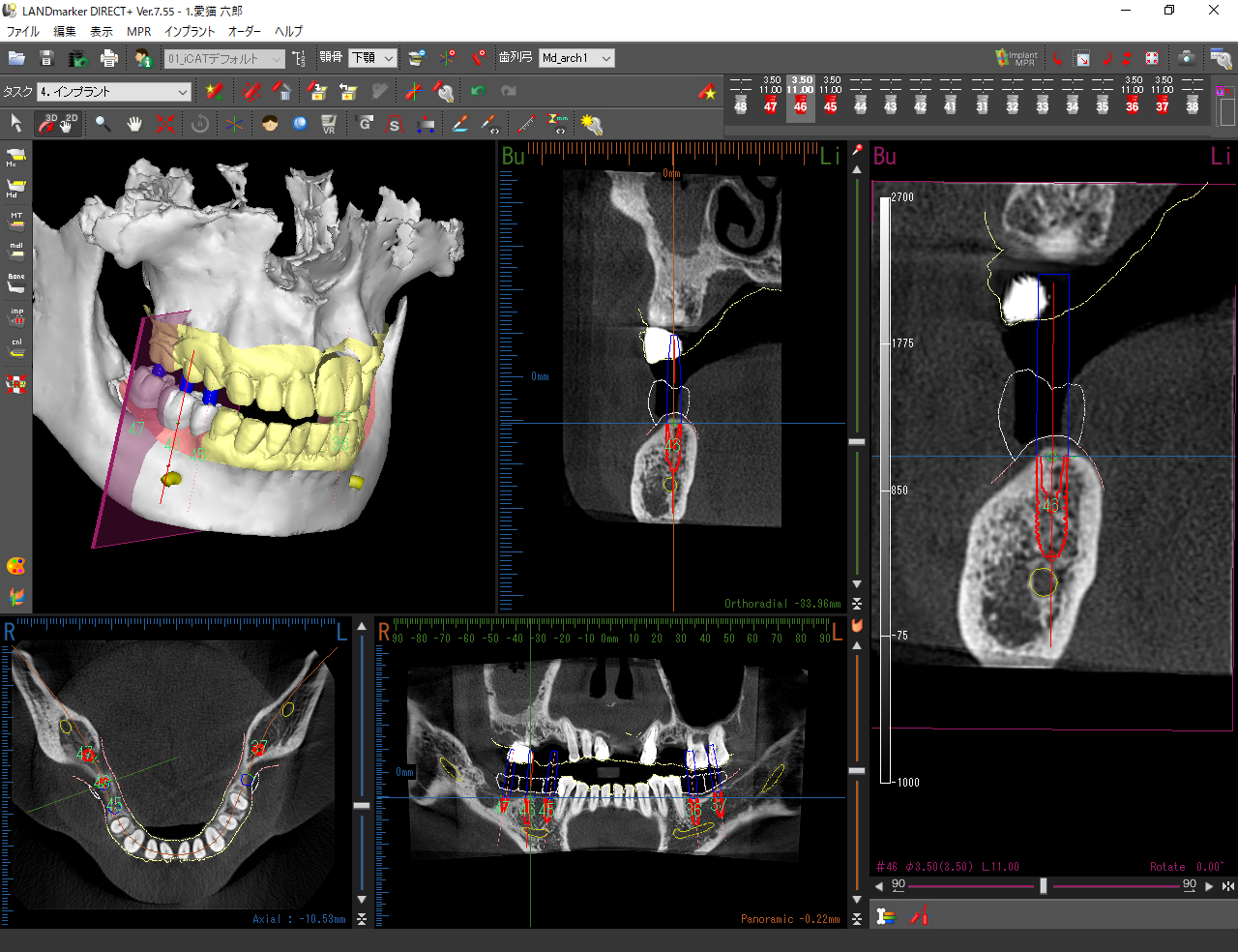 歯科用CT装置「RevoluX」の3D表示速度が約1/3に短縮！ 処理速度の向上