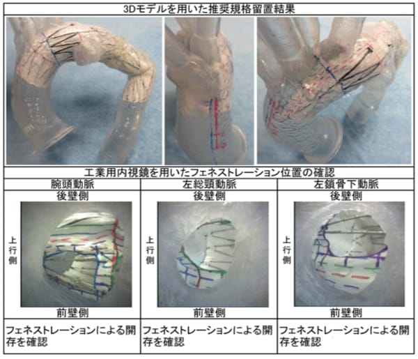 低侵襲治療（ステントグラフト内挿術など）｜順天堂医院 心臓血管外科