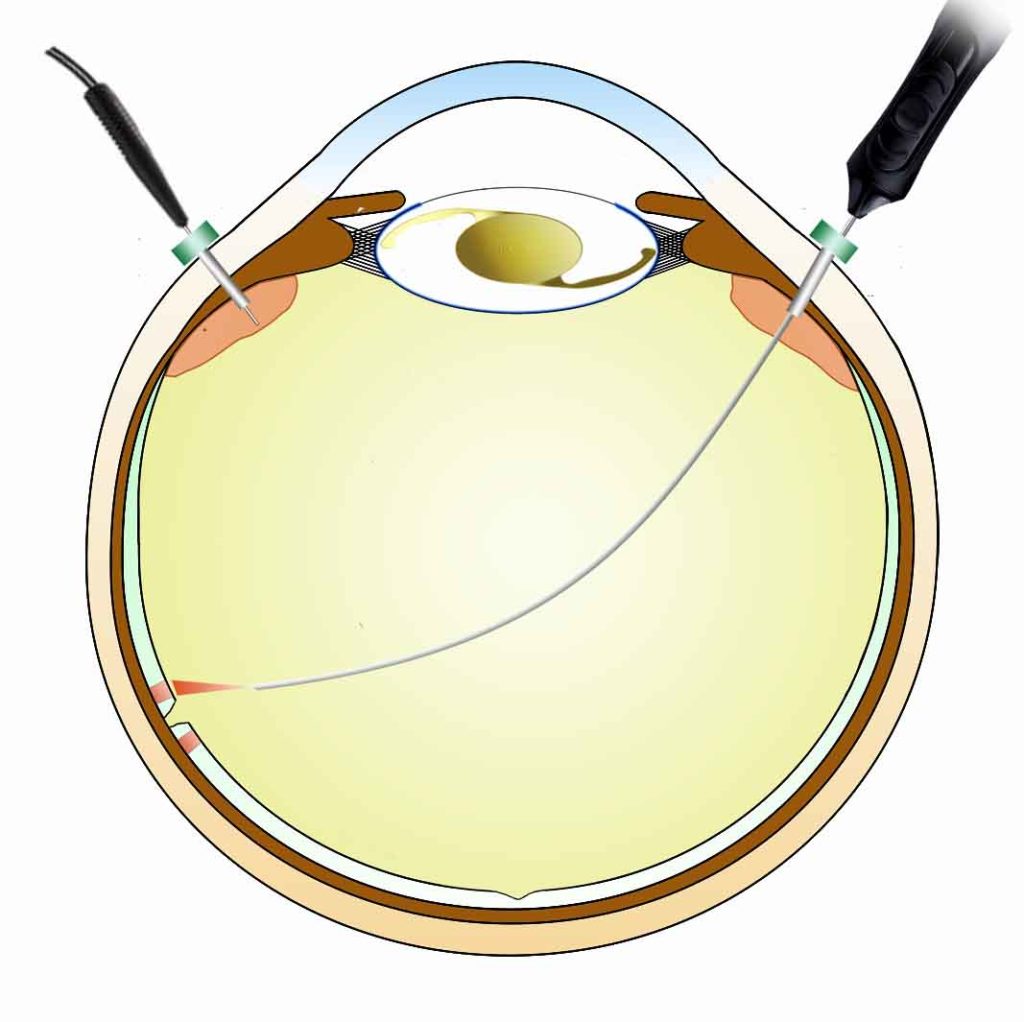 硝子体手術 - 亀谷アイクリニック