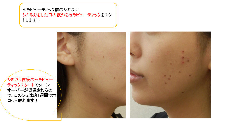 ガウディスキンセラピューティック治療の進め方 | 名古屋 金山の美容