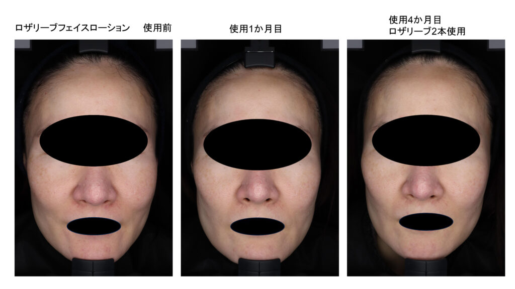 赤みのケア ロザリーブ症例 | 名古屋 金山の美容皮膚科・美容外科
