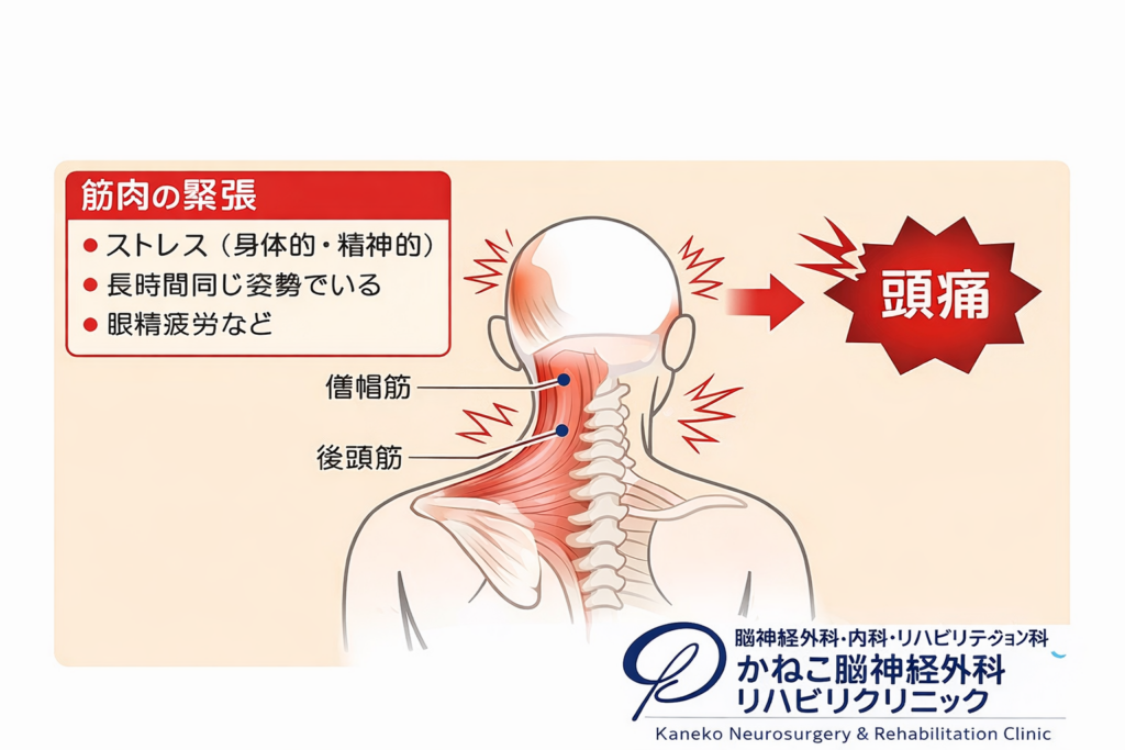 肩こりからくる頭痛でお悩みの方へ 😣～薬だけに頼らない“理学療法