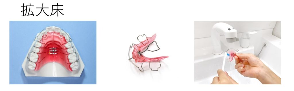 子どもの歯科矯正装置 拡大床について｜DOCTORʼS BLOG｜新浦安カタヤマ