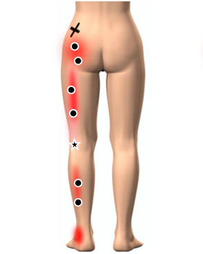 筋筋膜性疼痛症候群【MPS】痛みの引き金トリガーポイント｜痛みの事