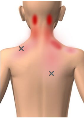 筋筋膜性疼痛症候群【MPS】痛みの引き金トリガーポイント｜痛みの事