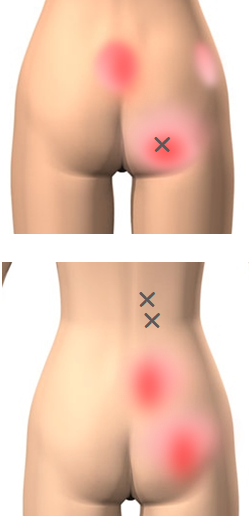 筋筋膜性疼痛症候群【MPS】痛みの引き金トリガーポイント｜痛みの事