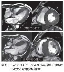 心アミロイドーシスの診療ガイドライン2025Ver.2 遠藤仁先生 | 川村