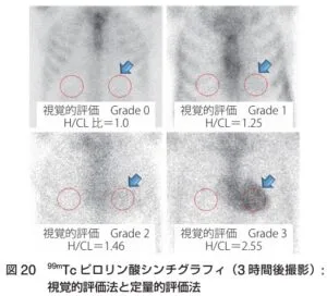 心アミロイドーシスの診療ガイドライン2025Ver.2 遠藤仁先生 | 川村
