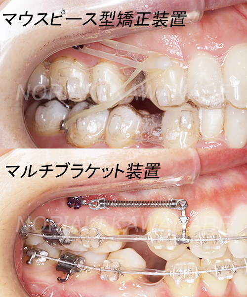 歯科矯正用アンカースクリューはどうやって使うの？ | 矯正歯科コラム