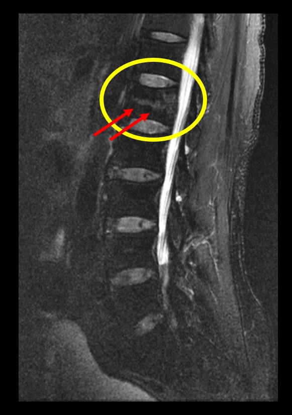レントゲン異常なしでも腰痛・しびれが続く方へ。MRIでわかる本当の