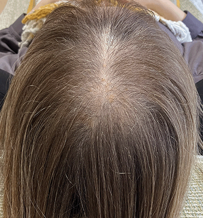 60代女性のお客様・増毛エクステ1000本の施術事例（神奈川県よりご来店