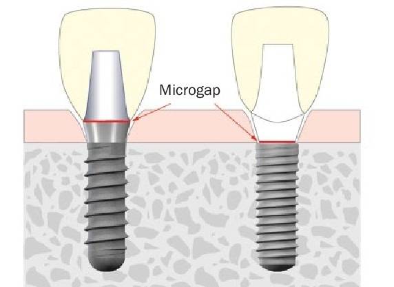 ティッシュレベルインプラント～インプラント周囲炎に強い～ | 診療へ