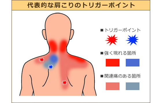 急な 痛み 疲れに効果 トリガーポイントと筋膜アプローチ - Kj北青山