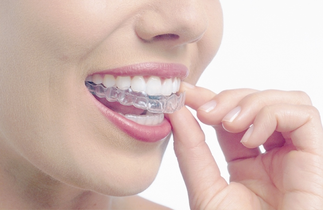 インビザライン（マウスピース矯正）のご案内 | 立川矯正歯科の近藤