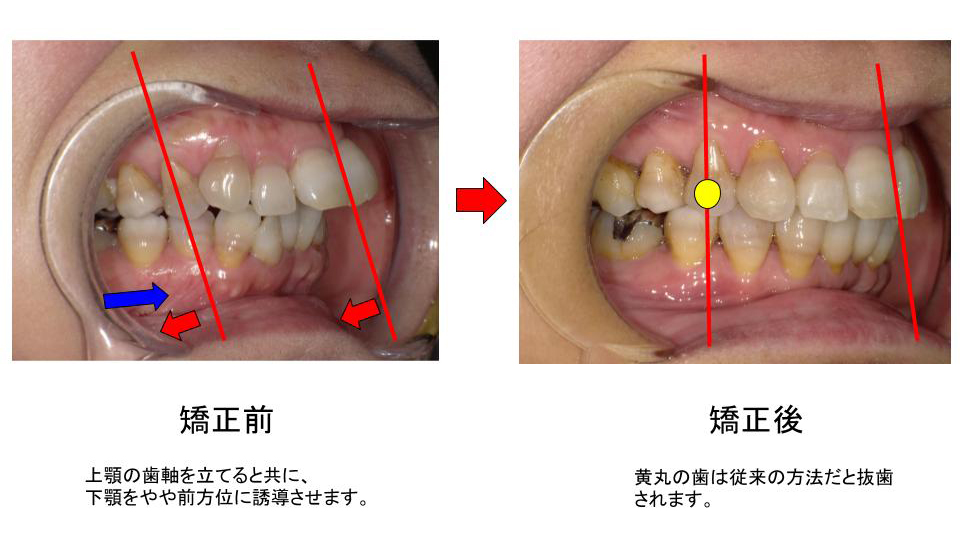 非抜歯矯正（小臼歯をぬかない）（手術をしない） - 小机歯科医院