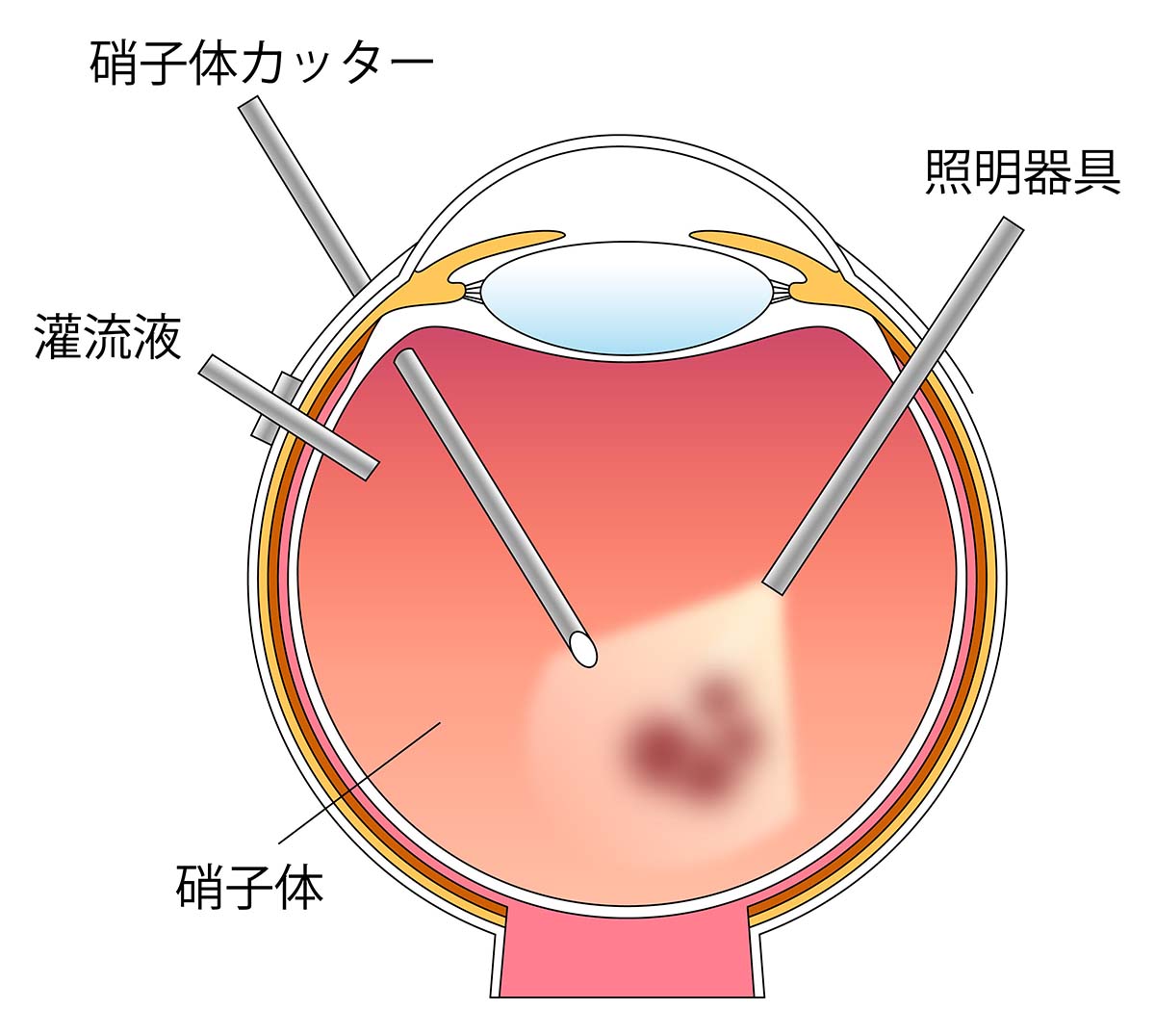 日帰り硝子体手術｜茨城県水戸市の小沢眼科内科病院