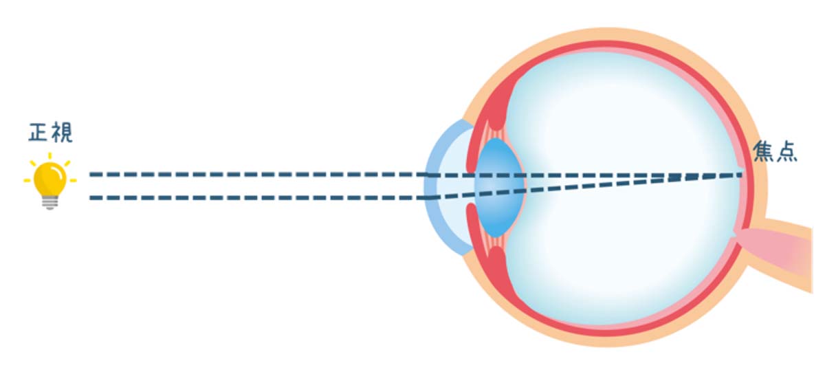 屈折異常（近視・遠視・乱視）｜茨城県水戸市の小沢眼科内科病院