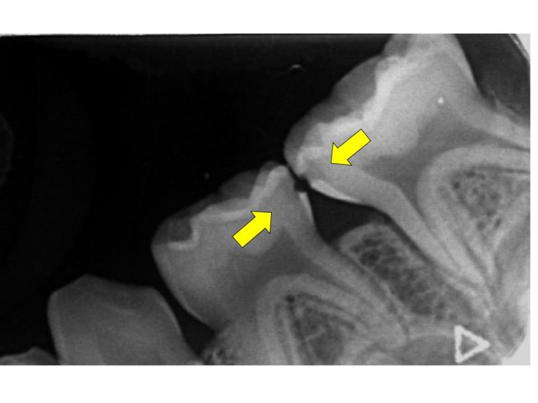 子供の歯の治療 - くぼくら歯科 | 大和市 桜ヶ丘 駅より1分 歯医者