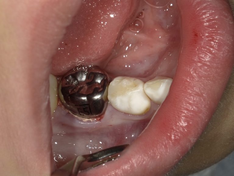 子供の歯の治療 - くぼくら歯科 | 大和市 桜ヶ丘 駅より1分 歯医者