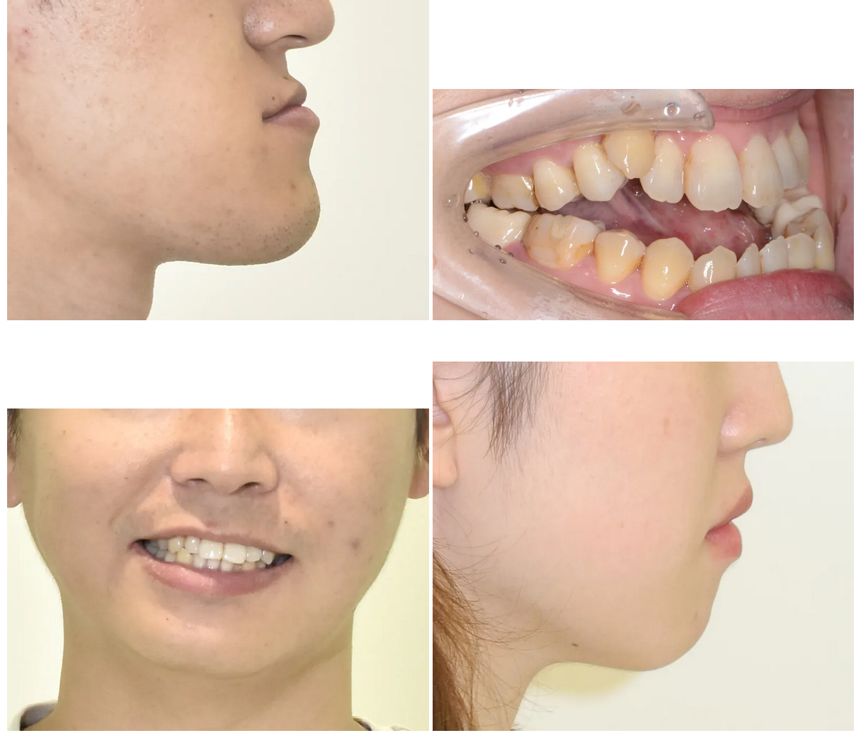 顎変形症の診断、治療について詳しく説明します - 【公式】日本橋