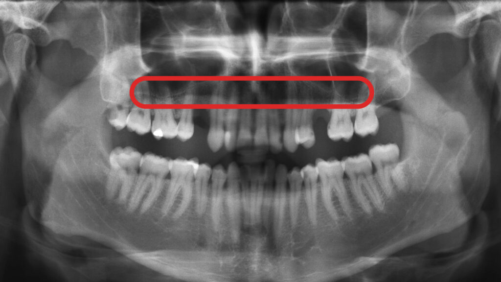 上顎洞底挙上術とは？ソケットリフトとサイナスリフトの違いも解説