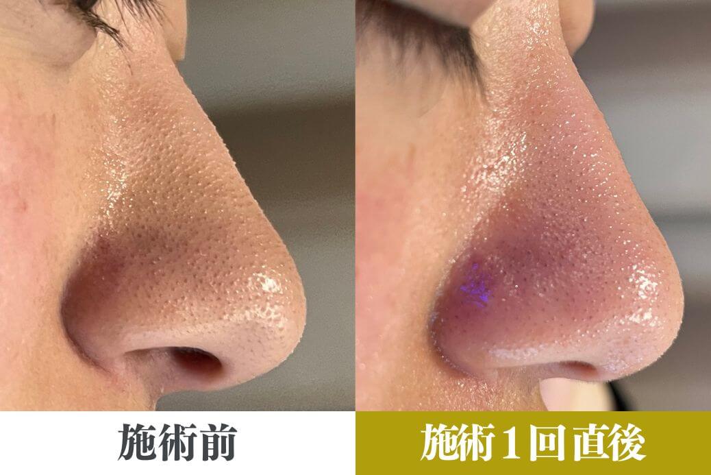 ハイドラフェイシャルの毛穴洗浄 - 【公式】ルナビューティー