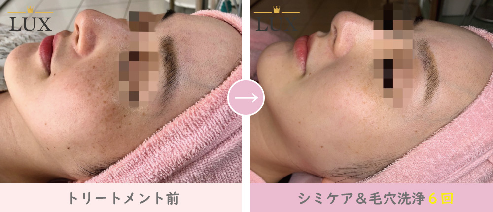 シミケア」と「毛穴洗浄」で効果倍増！セット施術が良い理由を紹介