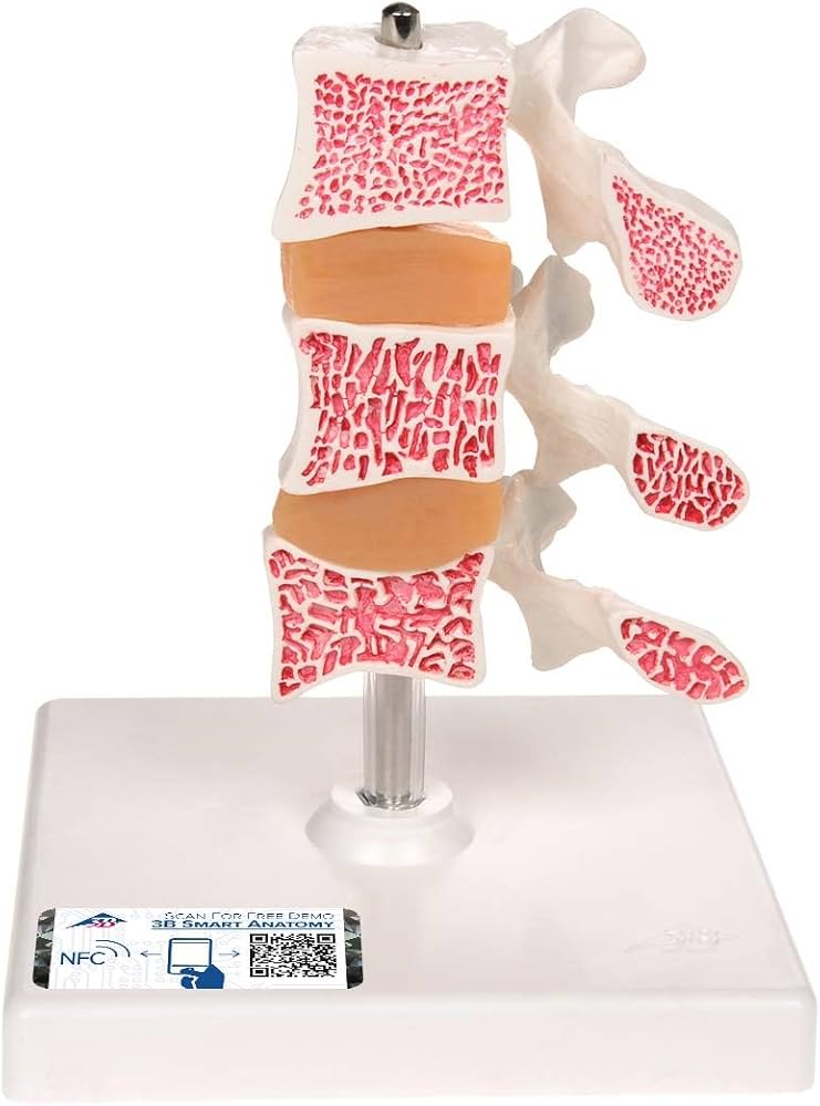 Amazon.co.jp: 骨粗しょう症を3段階（健康・骨密度の減少・圧迫変形