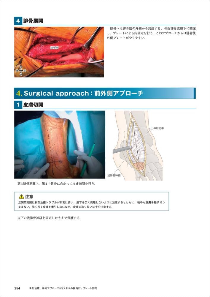 骨折治療 手術アプローチがよくわかる髄内釘・プレート固定 | 渡部 欣