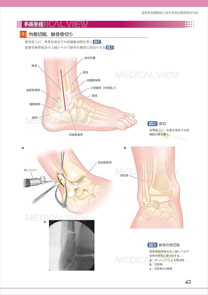 足・足関節の最新の手術 (OS NEXUS(電子版付き) 19) | 中村 茂 |本