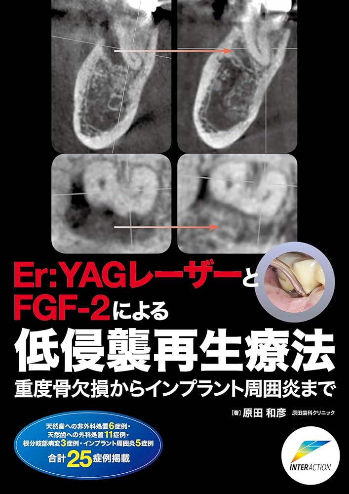 Amazon.co.jp: Er:YAGレーザーとFGF-2による低侵襲再生療法 : 原田