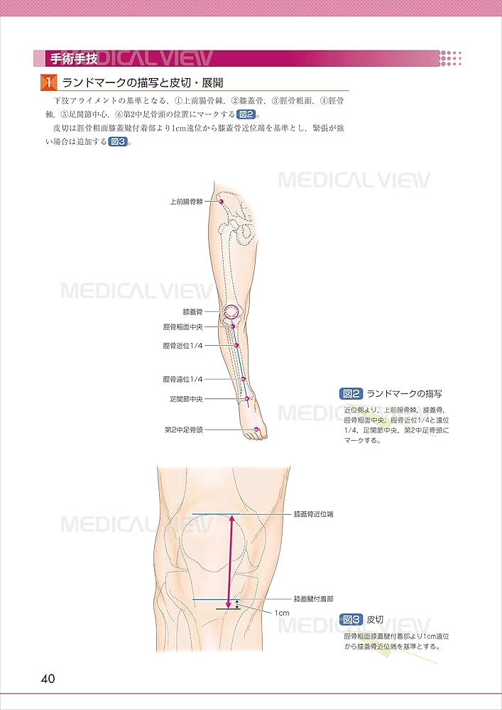 膝関節の再建法−最適な選択のために (OS NEXUS(電子版付き) 9) | 宗田